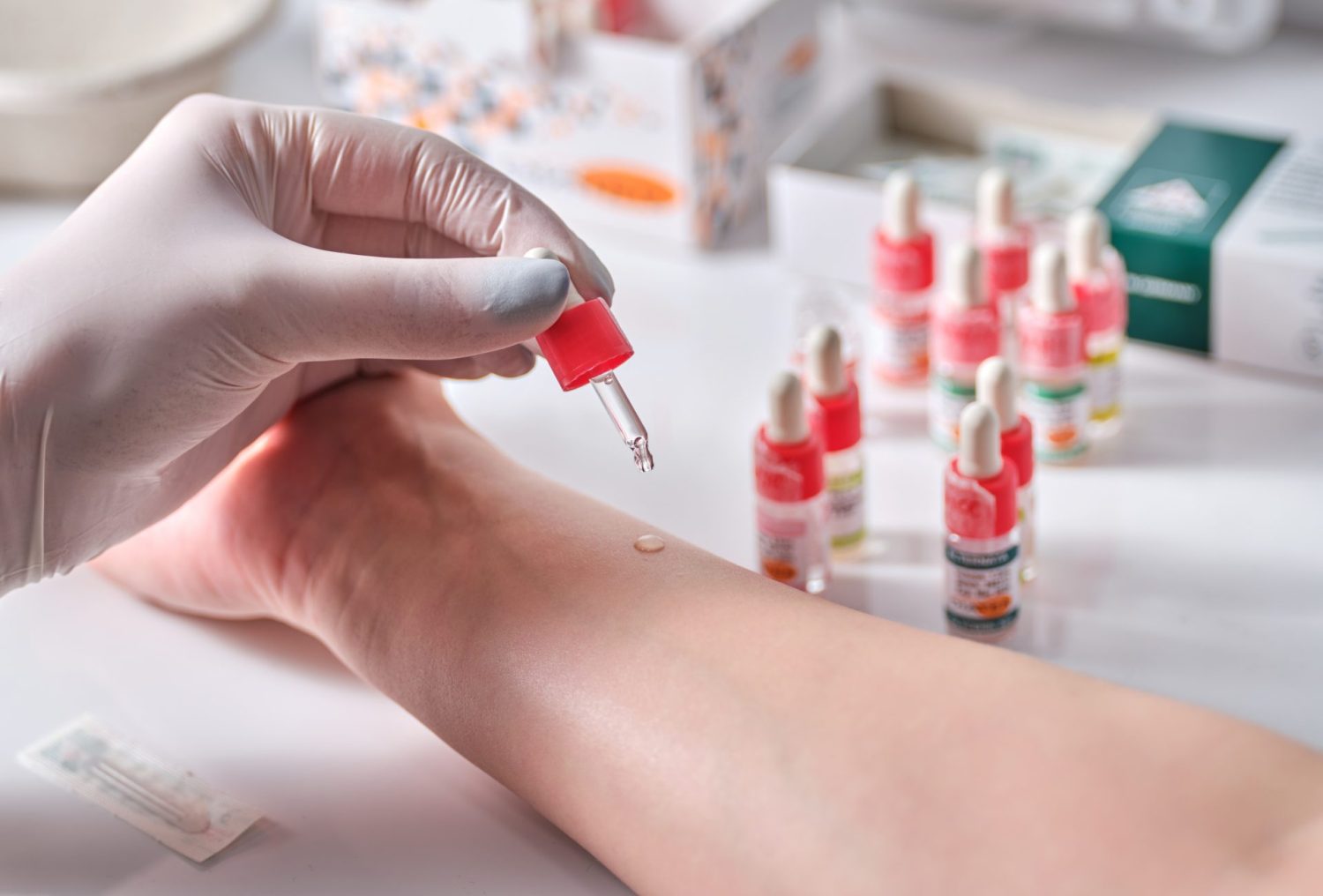 Kapljice alergena i ampule na koži pacijenta tijekom prick testa, alergije Solin