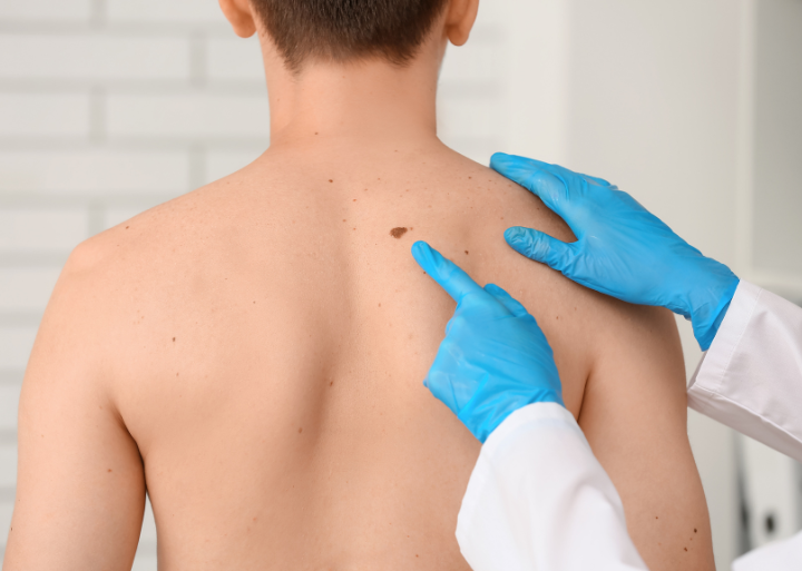 Priprema za kirurško uklanjanje madeža u lokalnoj anesteziji u Poliklinici MedPoint u Solinu