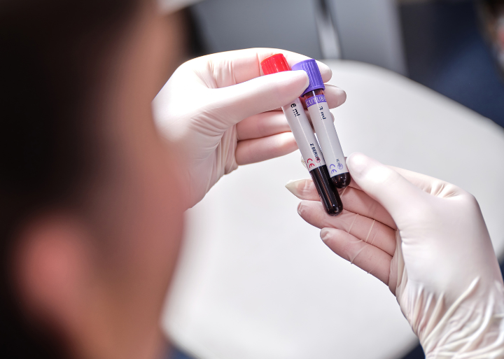 Epruveta s uzorkom krvi za laboratorijsku analizu - testiranje na celijakiju u Poliklinici MedPoint u Solinu